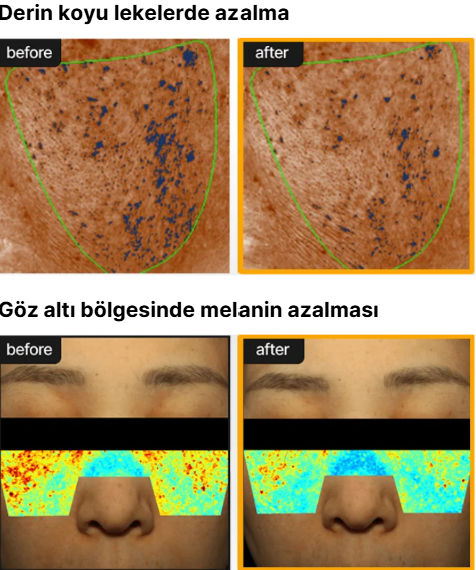 Koyu leke ve göz altı melanin görünümü öncesi sonrası değerlendirmesi